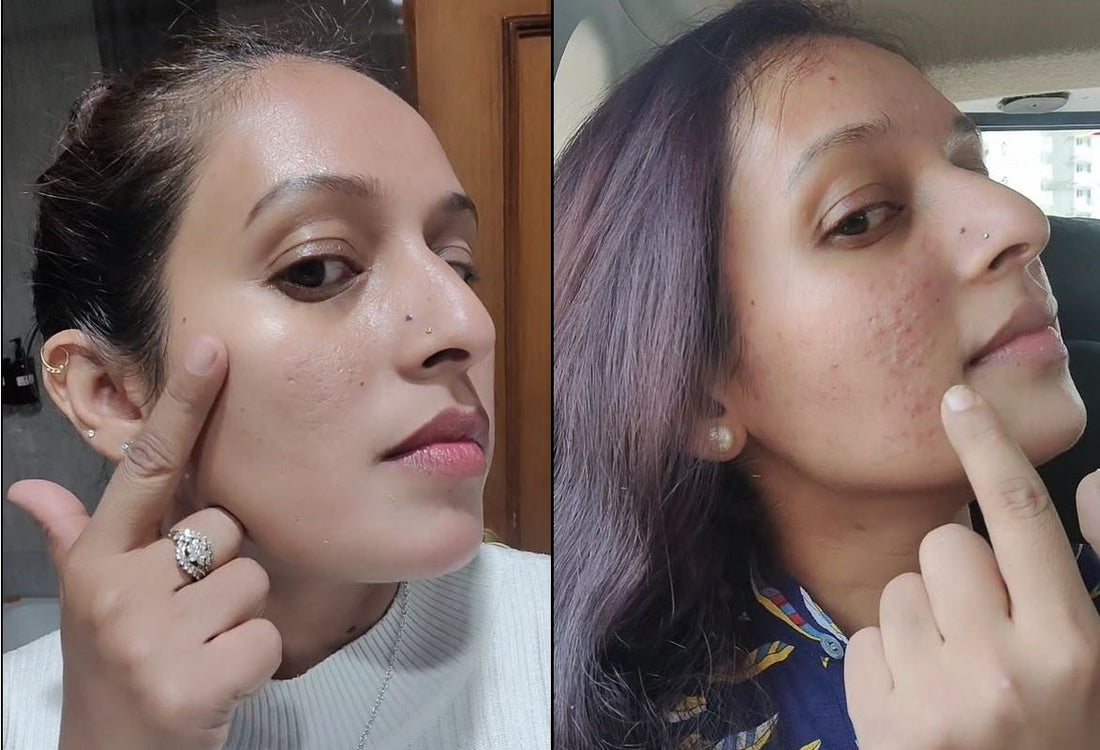 Skincare Routine for Acne, Blemishes, and Problem Skin